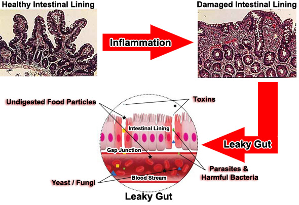 Leaky Gut Syndrome Developmental Process